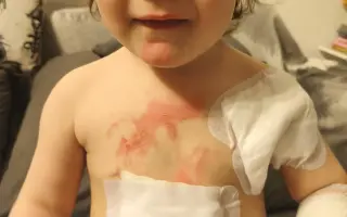 Pomohli ste bojovníčke Mii v tichom boji s ODLURO a Westovým syndrómom