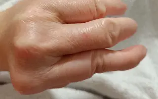 Pomôžme Zuzane zvládnuť obdobie liečby po operácii