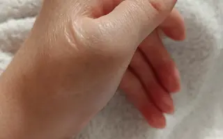 Pomôžme Zuzane zvládnuť obdobie liečby po operácii