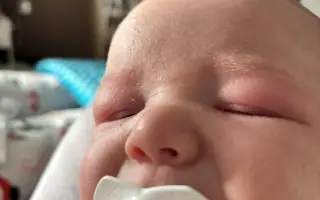 Pomôžme Sebkovi vrátiť jeho zdravú pokožku