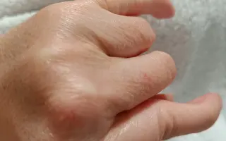 Pomôžme Zuzane zvládnuť obdobie liečby po operácii