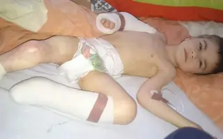 Pomôžme Kikovi pokračovať v náročnej liečbe zdeformovaných nožičiek