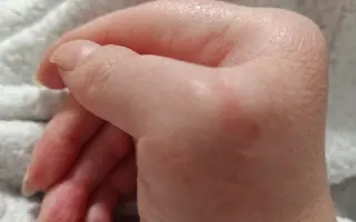 Pomôžme Zuzane zvládnuť obdobie liečby po operácii