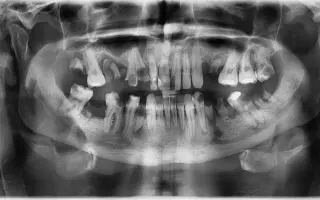 Pomôžme Kristiánovi s rekonštrukciou chrupu