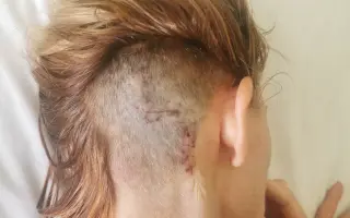 Pomôžte mi získať šancu na liečbu v zahraničí a poraziť nádory na mozgu