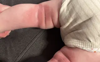 Pomôžme Sebkovi vrátiť jeho zdravú pokožku