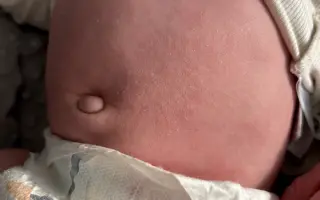 Pomôžme Sebkovi vrátiť jeho zdravú pokožku