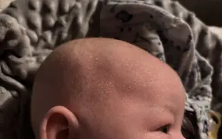 Pomôžme Sebkovi vrátiť jeho zdravú pokožku