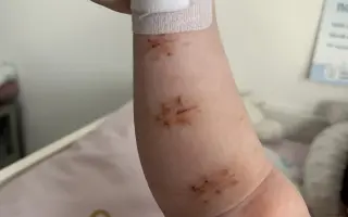 Pre Sofinku: Pomôžte 7-mesačnej bojovníčke rozhýbať ochrnutú rúčku